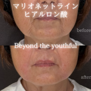名古屋で口角ヒアルロン酸の効果と料金相場｜60代女性がボリフトを選んだ理由の症例写真