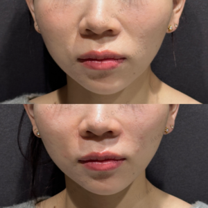 東京田町で鼻翼基部ヒアルロン酸｜ボリフトの効果と料金相場【20代女性】の症例写真
