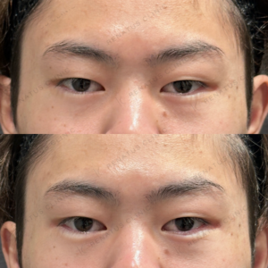 東京田町の涙袋ヒアルロン酸｜ボルベラで10代男性が自然な立体感を実現した費用と効果の症例写真