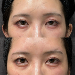 東京田町の涙袋ヒアルロン酸｜ボルベラで自然な涙袋を叶えた20代女性の効果と料金の症例写真
