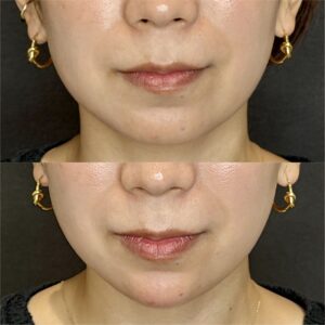 大阪梅田でヒアルロン酸・顎形成ならボラックス｜40代女性におすすめの効果と料金相場の症例写真