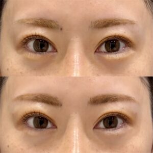 大阪梅田のヒアルロン酸｜目の上のくぼみに効果的な製剤と料金相場（ダイヤモンドフィール/ピネハ）30代女性の症例写真