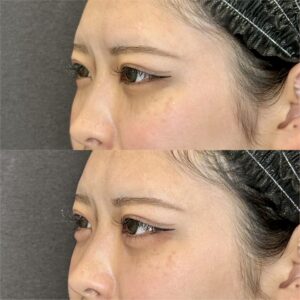 大阪梅田で涙袋ヒアルロン酸｜20代女性がボルベラで自然な涙袋を作る効果・料金相場の症例写真