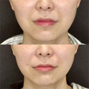 大阪梅田のほうれい線・鼻翼基部ヒアルロン酸｜ボリューマで自然な若返り【30代女性】の症例写真