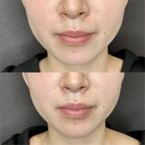 大阪梅田のヒアルロン酸顎形成｜ボラックスで理想の小顔を叶えた20代女性の効果と料金の症例写真