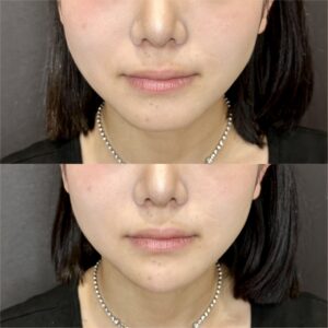 大阪梅田で顎ヒアルロン酸（ボラックス）の効果と料金｜20代女性のリアル体験の症例写真