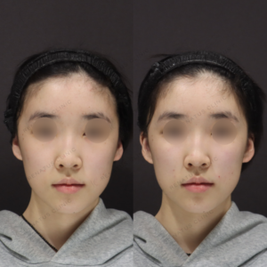 新宿でゴルゴラインにヒアルロン酸｜10代女性がボリューマで若返り効果を実感の症例写真