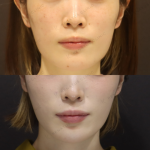 新宿で糸リフトを受けた20代女性の体験｜費用・効果・リアルな口コミを公開の症例写真