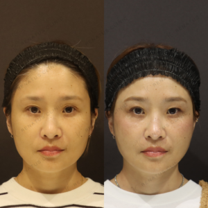 新宿でヒアルロン酸が上手い医師による40代女性の症例｜糸リフト併用で効果的なエイジングケアの症例写真