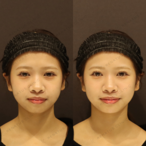 新宿で顎ヒアルロン酸が上手いクリニックは？ダイヤモンドフィール使用・20代女性のリアル体験の症例写真