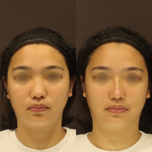 新宿のヒアルロン酸で鼻を高く｜ボラックスの効果と料金を20代女性が解説の症例写真
