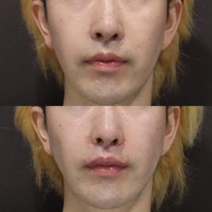 新宿の鼻翼基部ヒアルロン酸｜ボリフトで30代男性の鼻筋を自然に整える効果と料金の症例写真
