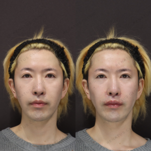 新宿の鼻翼基部ヒアルロン酸｜ボリフトの効果・料金を30代男性が解説の症例写真