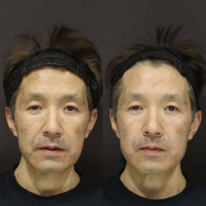新宿でゴルゴラインのヒアルロン酸が上手い名医｜ダイヤモンドフィール使用・50代男性の効果の症例写真