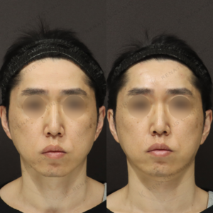 新宿のヒアルロン酸額注入｜40代男性にボリフトの効果と料金相場の症例写真