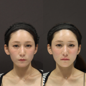 新宿で唇ヒアルロン酸ボルベラ｜20代女性の費用・効果・持続期間の症例写真