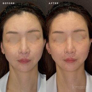 名古屋でヒアルロン酸が上手いクリニックの費用・効果・持続期間を解説の症例写真