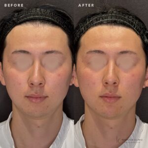 名古屋で顎ヒアルロン酸（ボラックス）20代男性の効果と費用を解説の症例写真