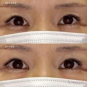 名古屋で目の上のヒアルロン酸｜40代女性がボルベラで若返りを実感した効果と料金の症例写真