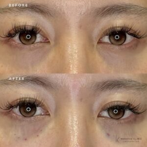 名古屋でヒアルロン酸注射おすすめ｜ボルベラで額・眉間・ほうれい線を自然に若返り【30代女性】の症例写真