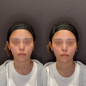 名古屋で顎ヒアルロン酸をボラックスで整えた20代女性の効果と料金の症例写真