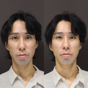 新宿で鼻翼基部ヒアルロン酸（ダイヤモンドフィール/ピネハ）40代男性の効果と料金の症例写真