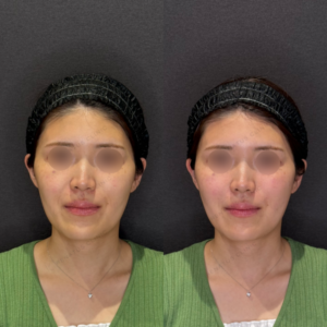 名古屋でほうれい線ヒアルロン酸｜20代女性がボリューマで実感した効果と料金の症例写真