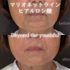 名古屋で口角ヒアルロン酸の効果と料金相場｜60代女性がボリフトを選んだ理由の症例写真