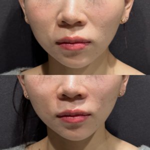 東京田町で鼻翼基部ヒアルロン酸｜ボリフトの効果と料金相場【20代女性】の症例写真