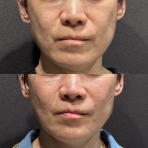 東京田町のヒアルロン酸リフトアップ｜50代男性がボリューマで実感した効果と費用の症例写真