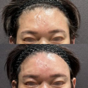 東京田町で額ヒアルロン酸｜50代男性がボリューマで若返り・費用と効果を公開の症例写真