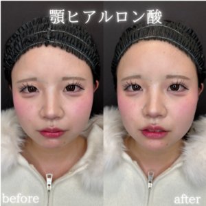 大阪梅田のヒアルロン酸注射で顎を整える｜10代女性の顎形成効果と費用（ダイヤモンドフィール/ピネハ）の症例写真