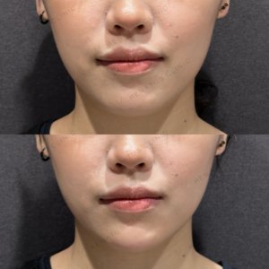東京田町の顎ヒアルロン酸｜20代女性がボラックスで叶えた小顔・費用と効果の症例写真