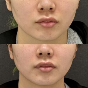 福岡天神のヒアルロン酸で鼻翼基部を整えた20代女性の記録｜ボリューマの効果と料金の症例写真
