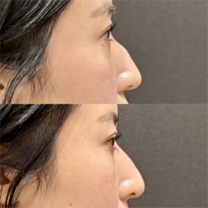 大阪梅田の鼻ヒアルロン酸｜ボラックスで20代女性が実感した効果と料金相場の症例写真