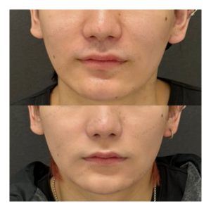 福岡天神のゴルゴラインヒアルロン酸・糸リフト｜20代男性がボリューマで実感した効果と料金相場の症例写真