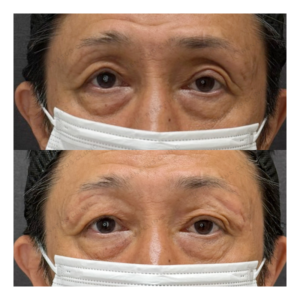 福岡天神のヒアルロン酸目の上｜ボルベラで50代男性がハリ復活・効果と費用の症例写真