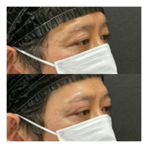 福岡天神でヒアルロン酸（目の上）｜50代男性がボルベラで若返り効果を実感の症例写真