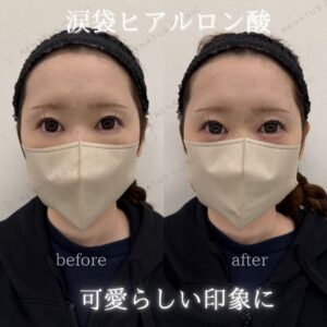 仙台で涙袋ヒアルロン酸｜30代女性がボルベラで自然な涙袋を叶えた効果と料金の症例写真
