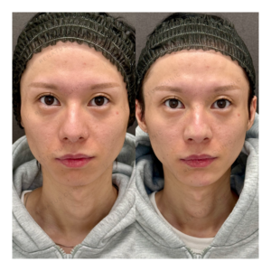福岡天神のヒアルロン酸顎形成｜ダイヤモンドフィールで叶える30代男性のシャープな輪郭の症例写真