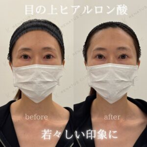 仙台で目の上ヒアルロン酸｜ボルベラで30代女性が若返り・料金と効果を解説の症例写真
