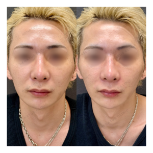 福岡天神でヒアルロン酸ほうれい線・鼻翼基部｜20代ボリューマ・ボリフト効果と料金相場の症例写真