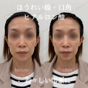 仙台でヒアルロン酸が上手いクリニック｜ほうれい線・口角にボリフト（VOLIFT）30代女性の費用と効果の症例写真