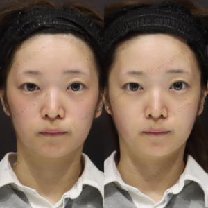 新宿でヒアルロン酸（ボリフト）頬に入れるなら｜20代女性の効果と料金相場の症例写真