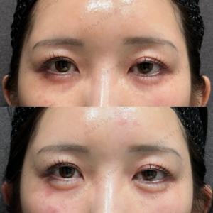 東京田町で涙袋ヒアルロン酸｜ボルベラで自然な涙袋を叶えた20代女性の効果と料金相場の症例写真