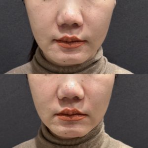 東京田町で鼻翼基部ヒアルロン酸の効果と料金相場｜ボリフト使用・40代女性の症例写真