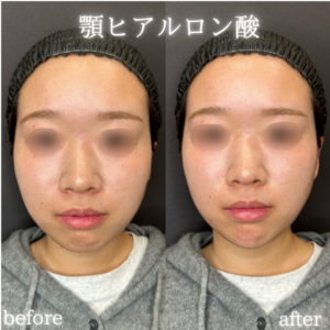 大阪梅田で顎ヒアルロン酸の効果が知りたい20代女性必見｜ボラックス（VOLUX）の料金相場の症例写真