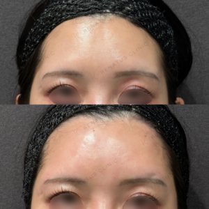 東京田町｜ヒアルロン酸・額＆こめかみにボリューマで自然なボリュームアップ｜30代女性の費用と効果の症例写真