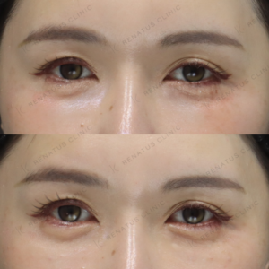 新宿で涙袋ヒアルロン酸が上手いクリニック｜ボルベラで自然な涙袋形成【40代女性】の症例写真