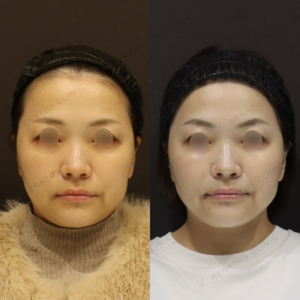 新宿でヒアルロン酸（ボライト）頬への効果と料金｜40代女性におすすめの症例写真